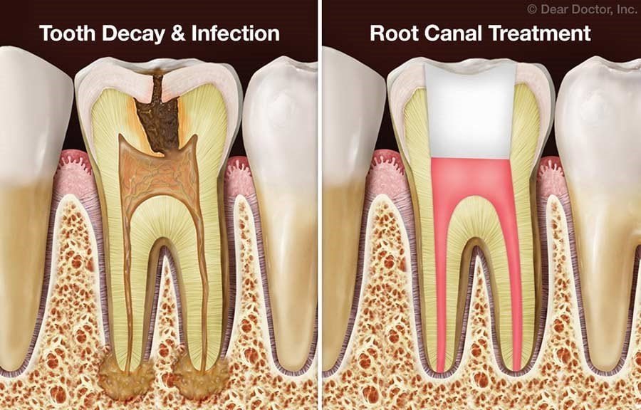 Pulp Cap vs. Root Canal